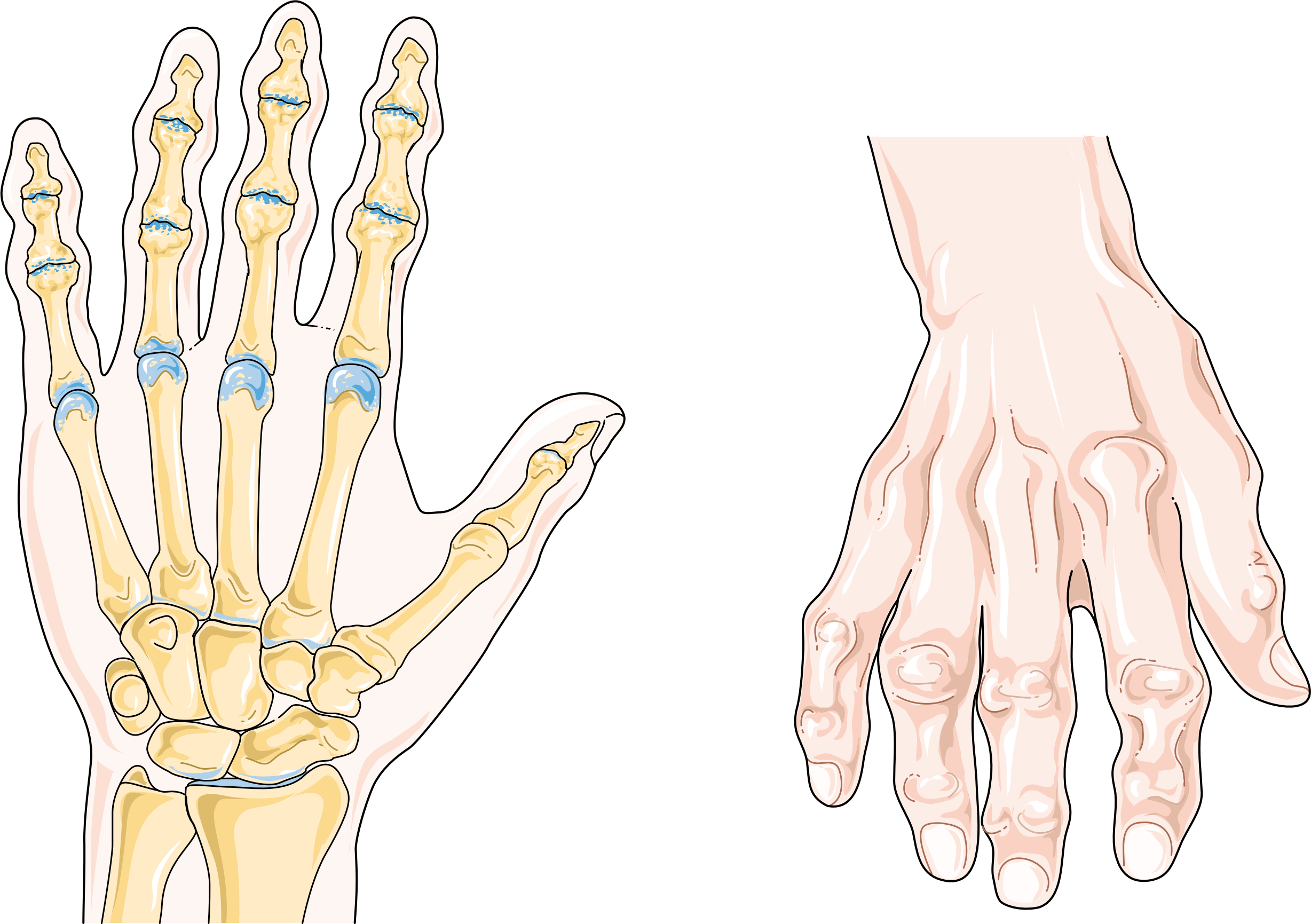 Kifosis, Skoliosis, dan Lordosis