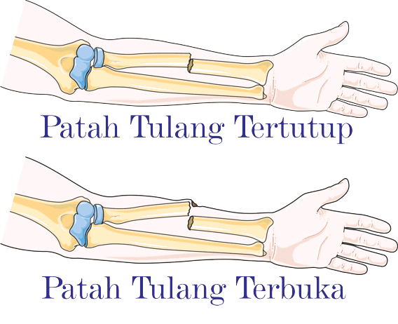 Patah Tulang